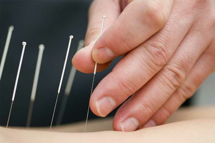 acupuncture